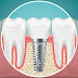 Osseointegration Surgery: Advancements in Dental Implant Technology