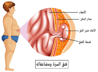 فتق السرة ومضاعفاته