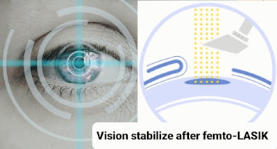 متى يستقر النظر بعد عملية الفيمتو ليزك وأهم النصائح الواجبة بعد العملية   When will vision stabilize after femto-LASIK