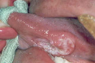 Tongue Cancer Pictures