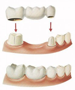 Cầu răng sứ là gì?