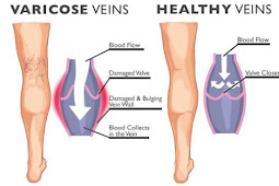 5 Cara Mencegah Varises Sejak Dini