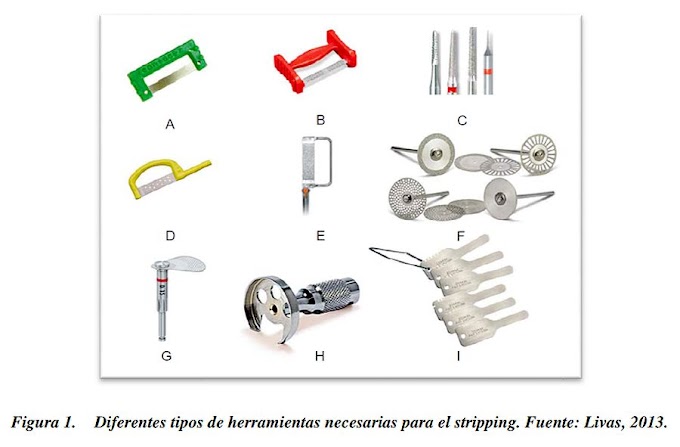 PDF: Alteraciones dentales y periodontales causadas por el stripping en ortodoncia