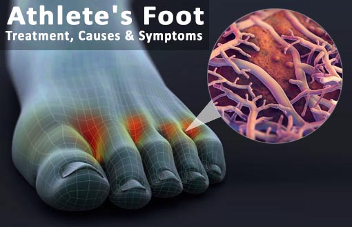 Athlete's Foot Treatment, Causes & Symptoms