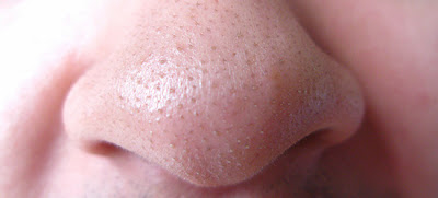 Get rid of blackheads on nose