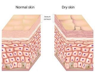 dry skin cause dermatitis