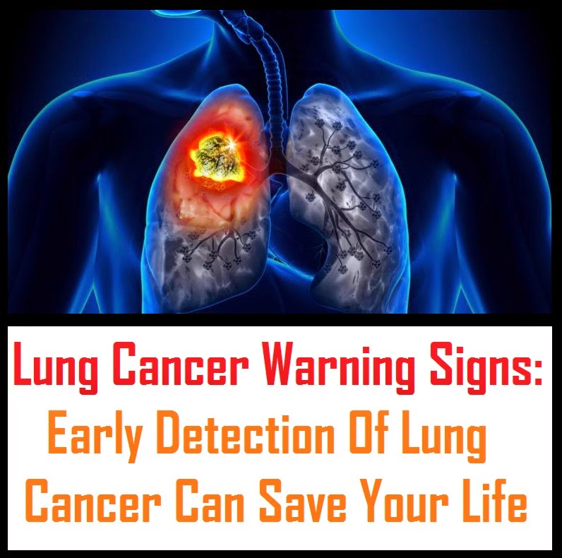 Lung Cancer Warning Signs Early Detection Of Lung Cancer Can Save Your Life