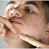 How Can A Guy Get Rid of Pimples Fast