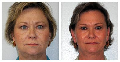 Mesotherapy Before And After