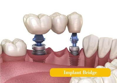 dental implant bridge