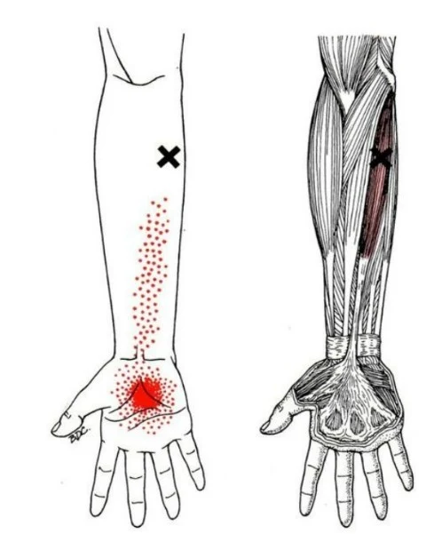 Antebrazo y muñeca - El musculo palmar largo o palmar menor   - MCdevservices Spa