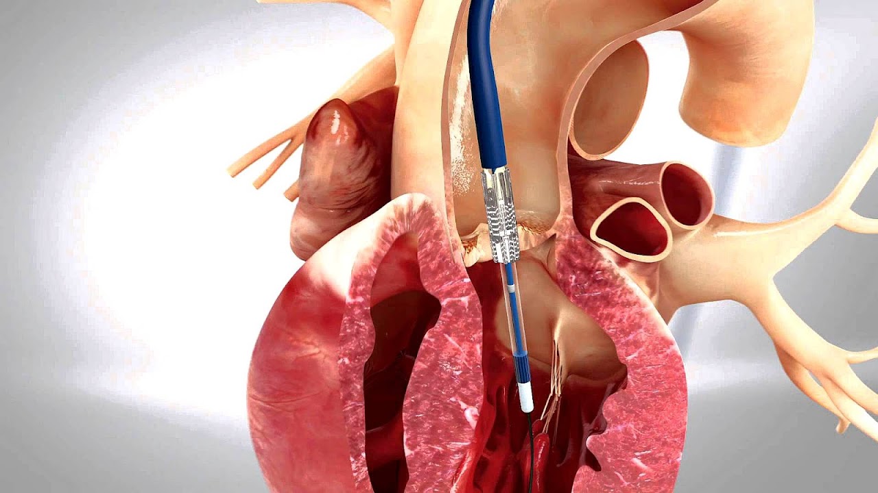 Percutaneous aortic valve replacement Hear