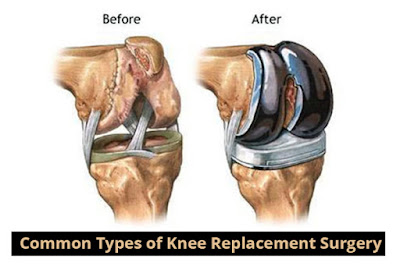 Knee Replacement Surgery