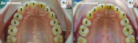 Центр зубов до и после ортодонтического лечения