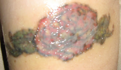 Chronicles of a Tattoo Removal: Days 6, 7, and 8....Itching!!!