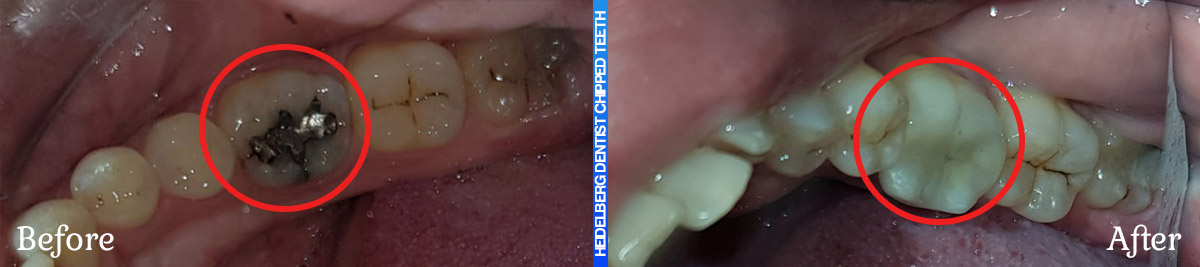 Before & After Smile Gallery For Chipped/Broken & Cracked Teeth