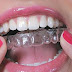  Có nên áp dụng niềng răng 3D Clear không?