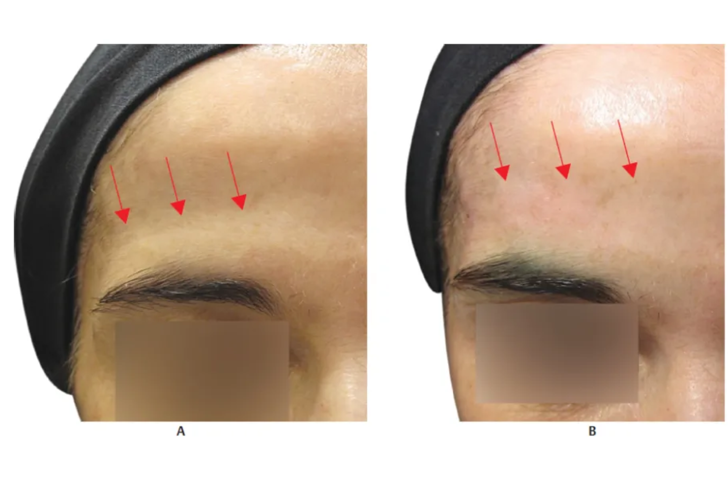 Forehead Filler: Achieve Smooth & Natural Results