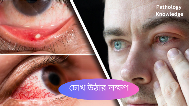 চোখ উঠার লক্ষণ