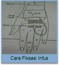 Cara fiksasi infus