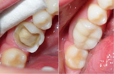 Phương pháp trám răng hàm dưới
