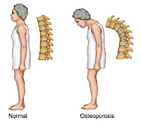 http://osteoporosistradisionalobat.blogspot.co.id/2015/10/mari-mengenal-tipe-tipe-osteoporosis.html