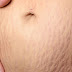 Oalah Ternyata ini Penyebab Stretch Mark