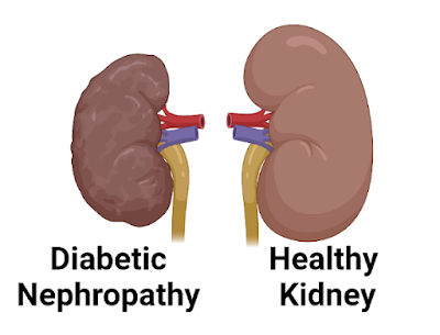 What Is Diabetic Nephropathy?