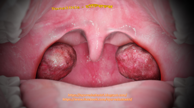 Tonsillitis - टॉन्सिल्स 