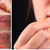 Oral Herpes Home Remedy