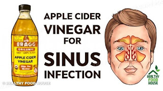 How To Kill Sinus Infection Within Minutes With Apple Cider Vinegar!