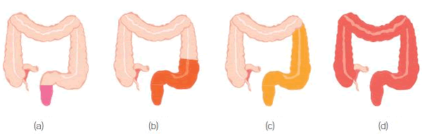 types of ulcerative colitis
