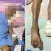 Mulher de 103 anos tem pé amputado sem anestesia por enfermeira no DF