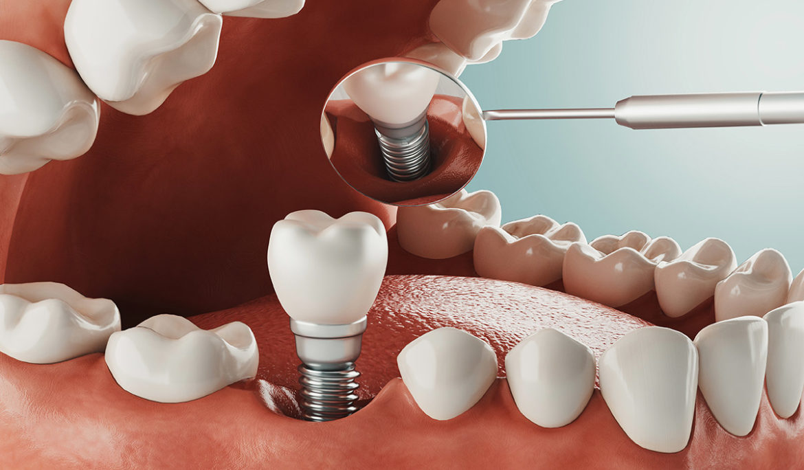 Dental Implants