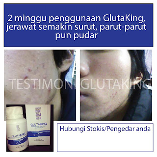 glutaking ainan tasneem, buy glutaking, side effect glutaking, kesan glutaking, testimonial glutaking, glutaking testimonial