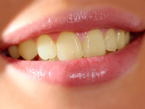 natural teeth whitening