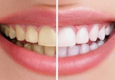 Răng bị vàng có tẩy trắng được không? Nên chọn cách nào? 1