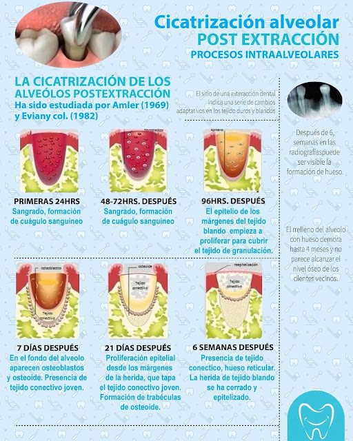 curacion luego de sacar muela