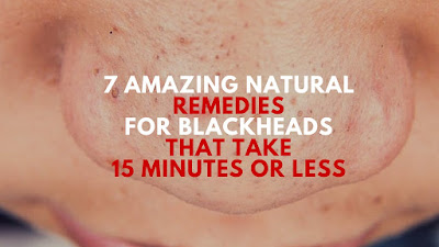 7 Amazing Natural Remedies For Blackheads That Take 15 Minutes or Less