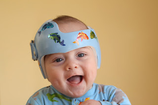 Plagiocephaly Treatment with Helmet