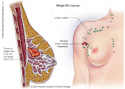 Like most cancers, the Stage 2 Breast Cancer 1st phase has a TNM staging .