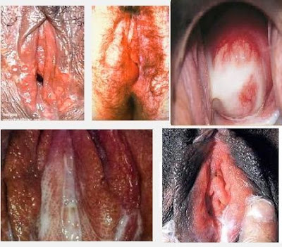 Jual Obat Vagina Mengeluarkan Nanah Dan Perih