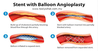 angioplasty