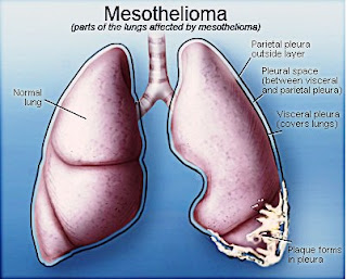 mesothelioma definition