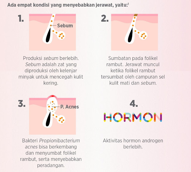 Penyebab Munculnya Jerawat