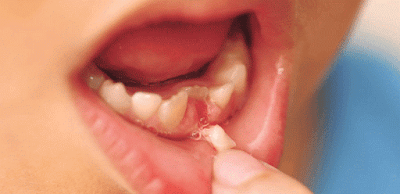 Những lưu ý khi nhổ răng sữa cho trẻ