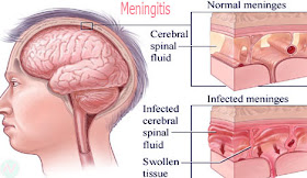 Meningitis,ঝিল্লীর প্রদাহ