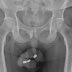 BIZARRO: IDOSO INSERE BATERIAS NA URETA E PERDE PARTE DO ÓRGÃO GENITAL