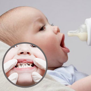 Baby-Bottle Caries