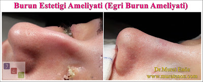 Burun estetiği ameliyatı - Bayan burun estetiği - Açık teknik burun estetiği ameliyatı - Eğri burun tedavisi - Eğri burun ameliyatı - Female Nose Aesthetic Surgery - Nose Jobs For Women - Nose Reshaping for Women - Best Rhinoplasty For Women Istanbul - Female Rhinoplasty Istanbul - Nose Job Surgery for Women - Women's Rhinoplasty - Nose Aesthetic Surgery For Women - Female Rhinoplasty Surgery in Istanbul - Female Rhinoplasty Surgery in Turkey - Eğri burun nedenleri - Eğri burun tanımı - Eğri burun estetiği - Eğri burun ameliyatı - Eğri burun tedavisindeki zorluklar - Crooked nose - Deviated nose - Twisted nose - Deflected nose - Asymmetric nose - Scoliotic nose - Eğri burun - C burun - S-shaped crooked nose deformity -  Rhinoplasty Istanbul - Rhinoplasty in Istanbul - Rhinoplasty Turkey - Rhinoplasty in Turkey – Rhinoplasty doctor in Istanbul – ENT doctor in Istanbul - Nose Job in Istanbul - Before and after rhinoplasty photos